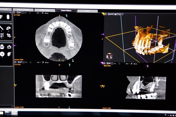 綾瀬（葛飾区小菅・堀切）の歯医者、あやせ ほりきり中央歯科口腔機能クリニックの保険診療で行う精密根管治療
