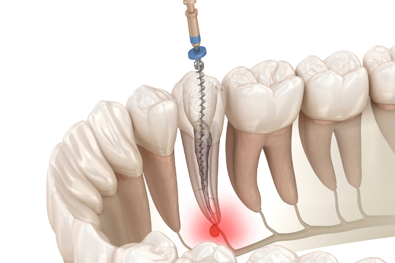 綾瀬（葛飾区小菅・堀切）の歯医者、あやせ ほりきり中央歯科口腔機能クリニックの保険診療で行う精密根管治療