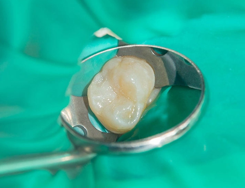 綾瀬（葛飾区小菅・堀切）の歯医者、あやせ ほりきり中央歯科口腔機能クリニックの保険診療で行う精密根管治療