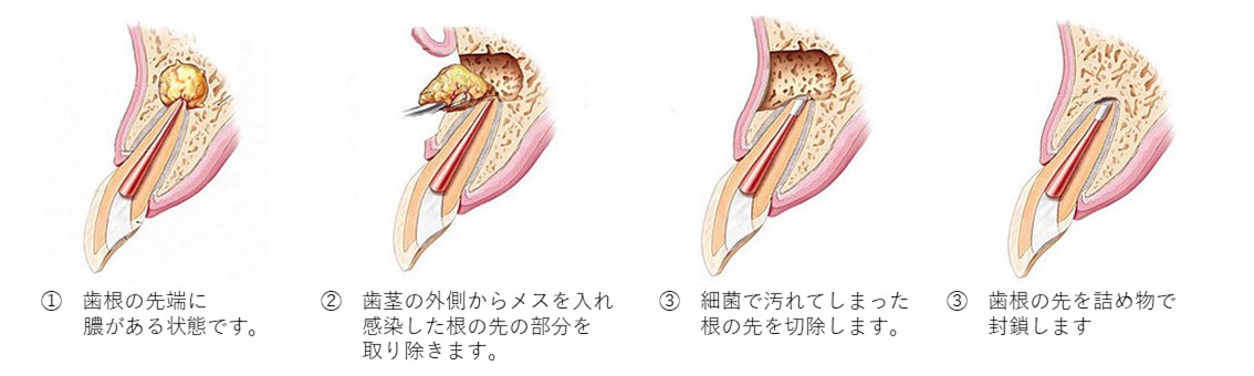 綾瀬（葛飾区小菅・堀切）の歯医者、あやせ ほりきり中央歯科口腔機能クリニックの保険診療で行う精密根管治療